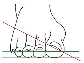 "Hallux valgus" – Das schmerzhafte Problem mit dem großen Zeh