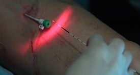 Lasertherapie gegen Krampfadern vervielfacht die Rückfallrate